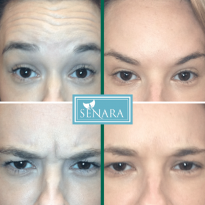 Botox Before & After Results on Forehead
