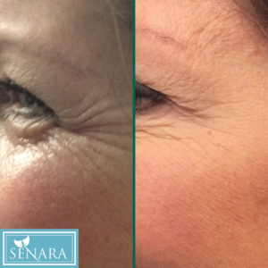 Botox Crow's Feet Before & After Results