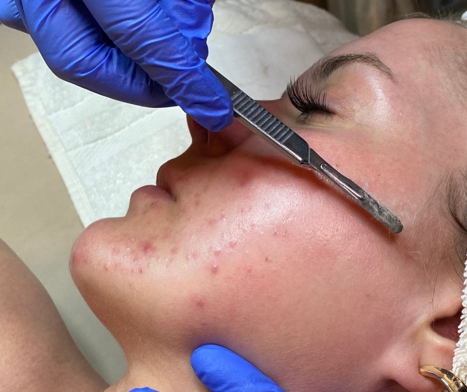 Dermaplaning Cass