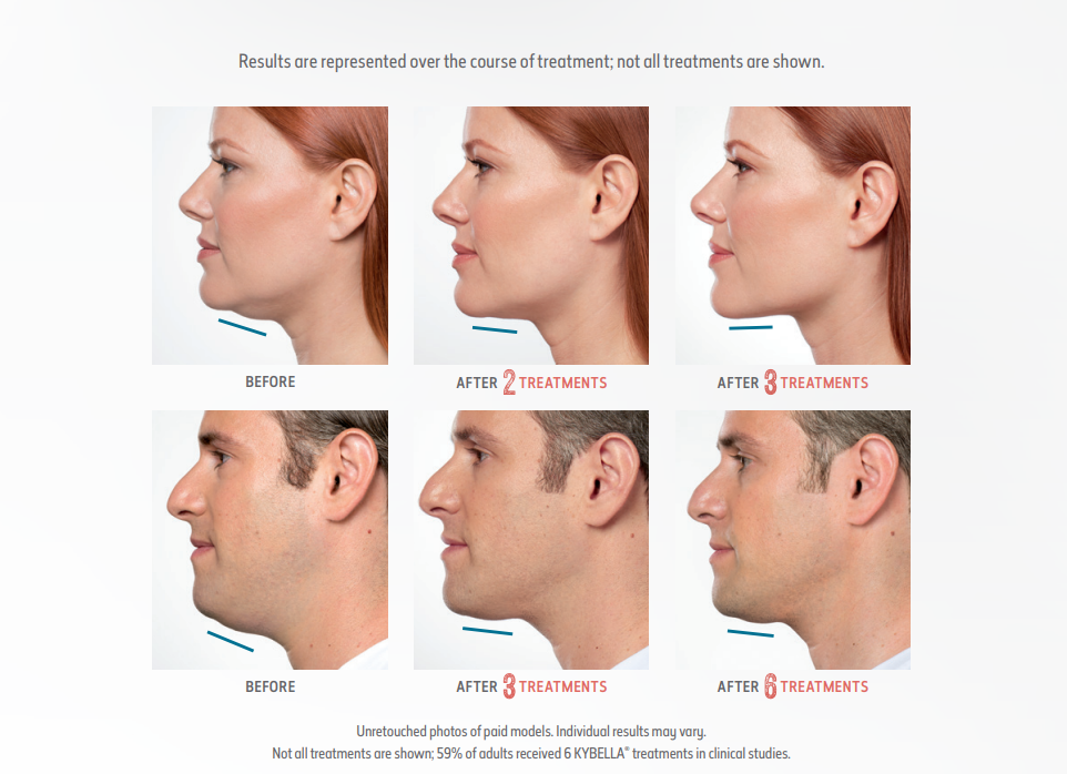Kybella tx progression