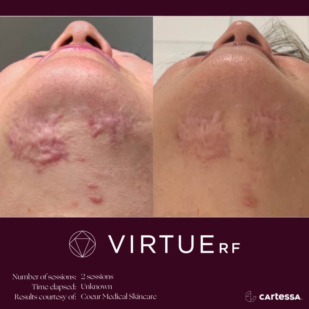 VirtueRFBAChinScar1-61ae4d0a46b90