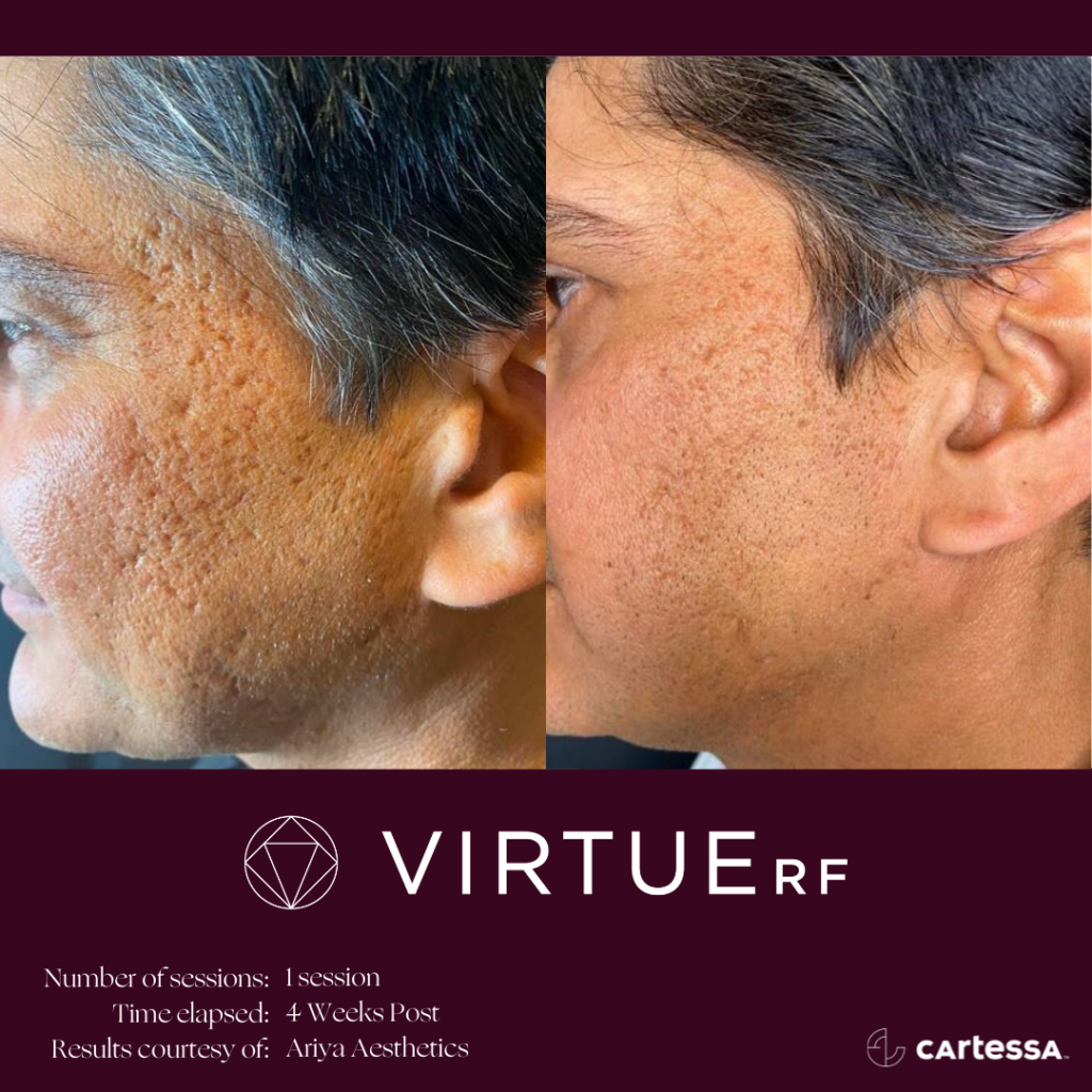 VirtueRFBAFaceAcneScars1-61ae4d0e4145c