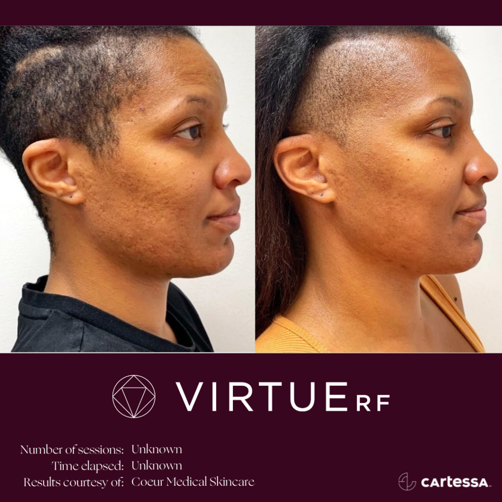 VirtueRFBAFaceAcneScars3-61ae4d15401b6