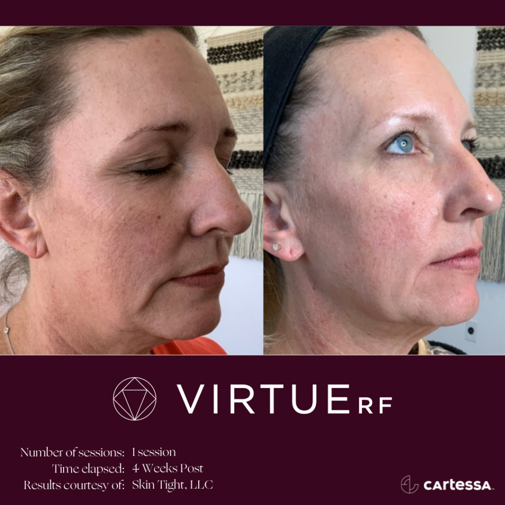 VirtueRFBAFemaleFaceFineLines2-61ae4d2b67996