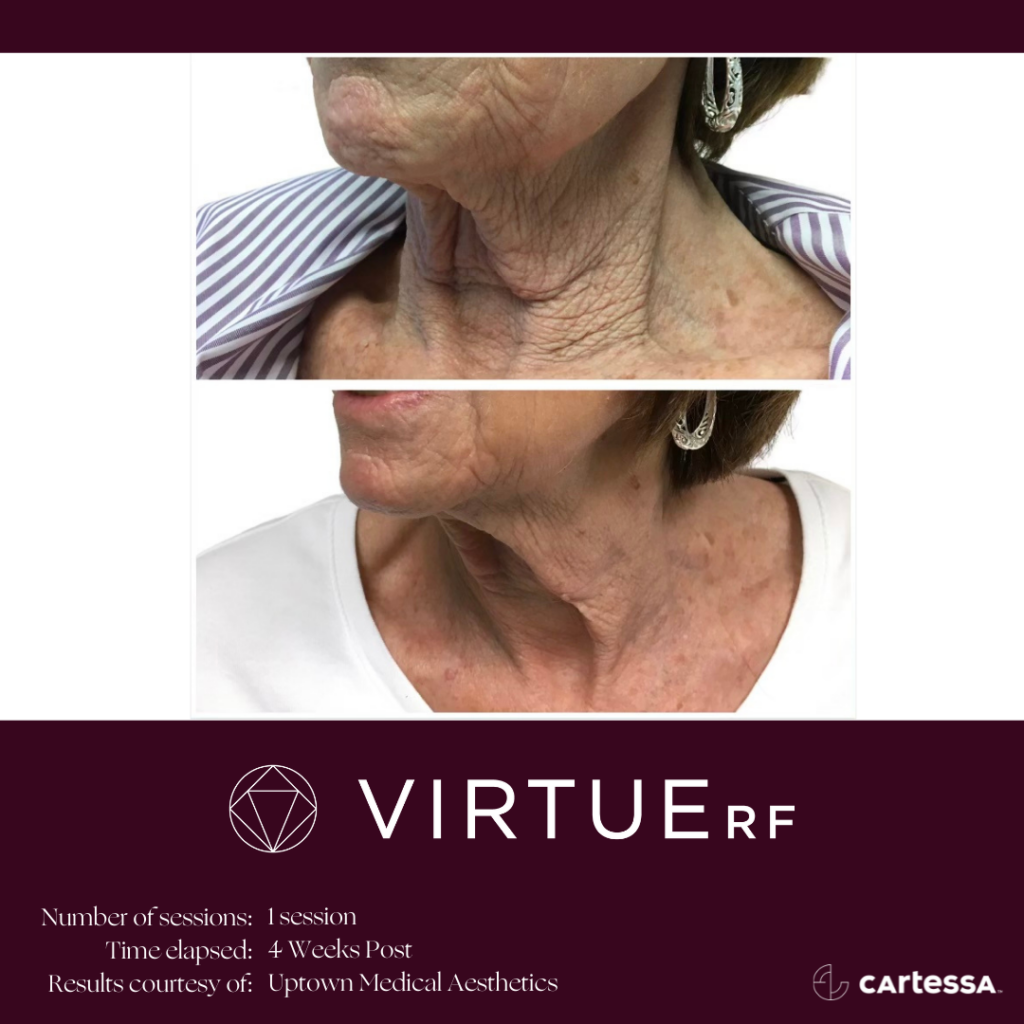 VirtueRFBANeckWrinkles3-61ae4d39bab6d