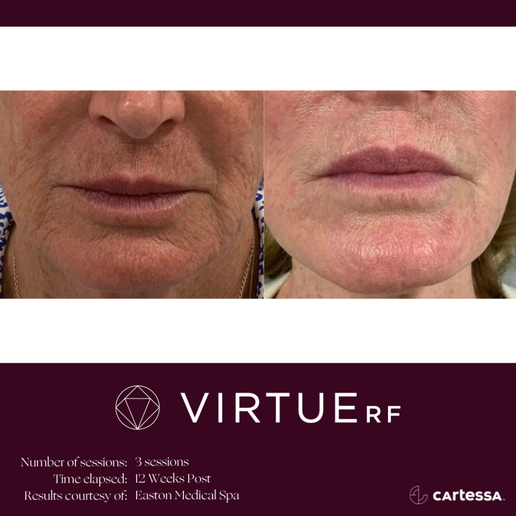 VirtueRFBAPerioralFineLines1-61ae4d3c862af