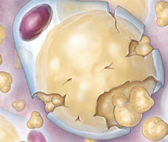 Dying Fat Cell After Kybella Treatment