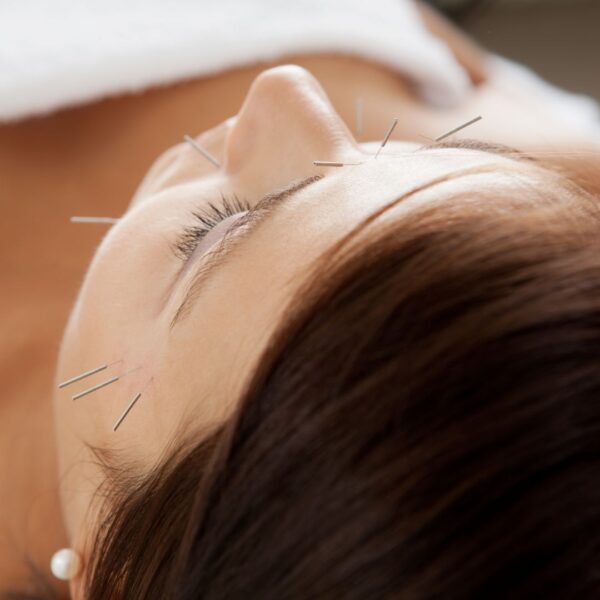 img of acupuncture 