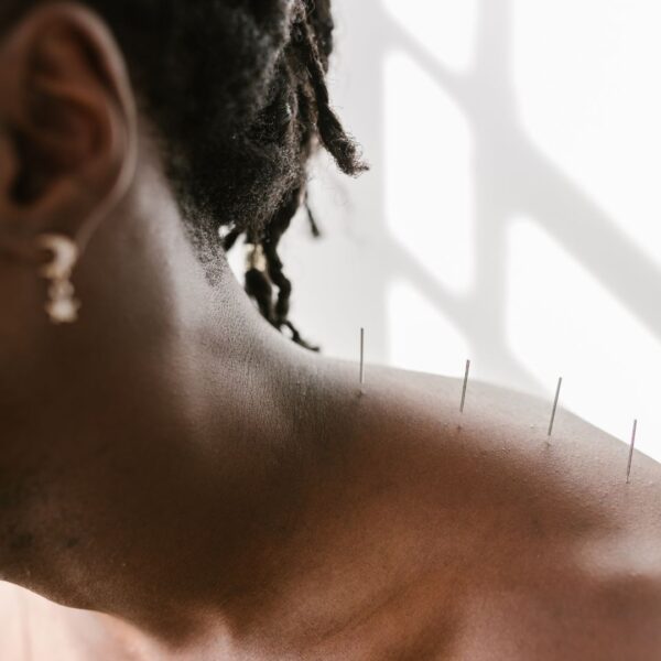 img of acupuncture 