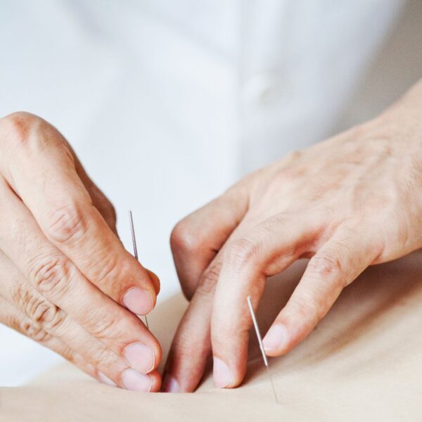 img of acupuncture