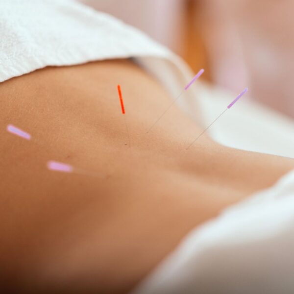 img of acupuncture