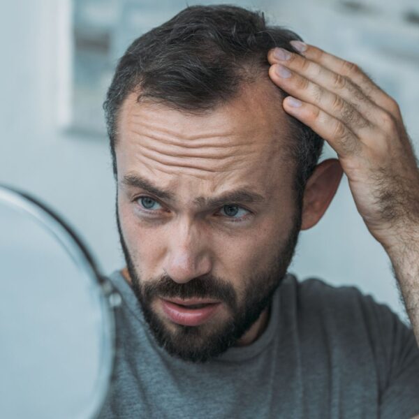 img of a man with hair loss 