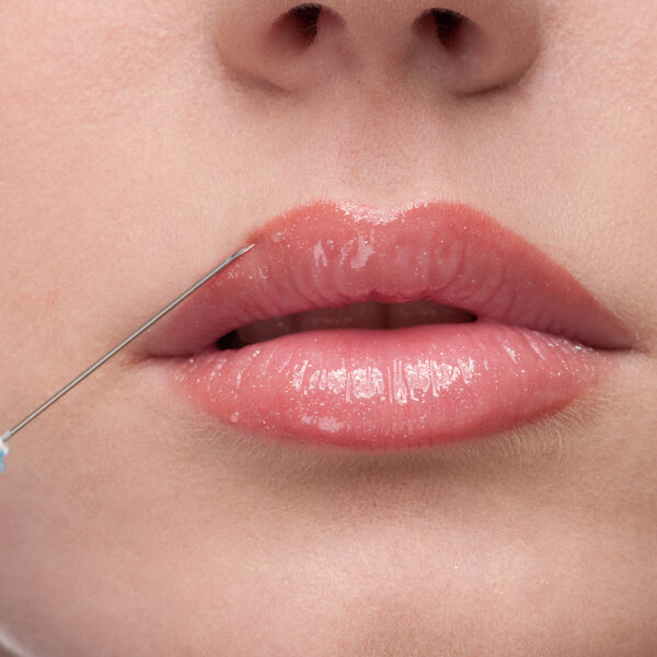 Close up of a woman getting botox in her lips