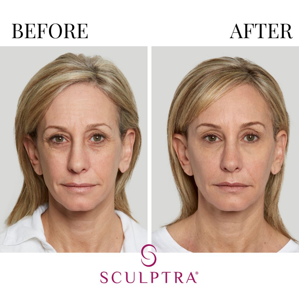 Botox + Fillers Before and Afters B &A (28)