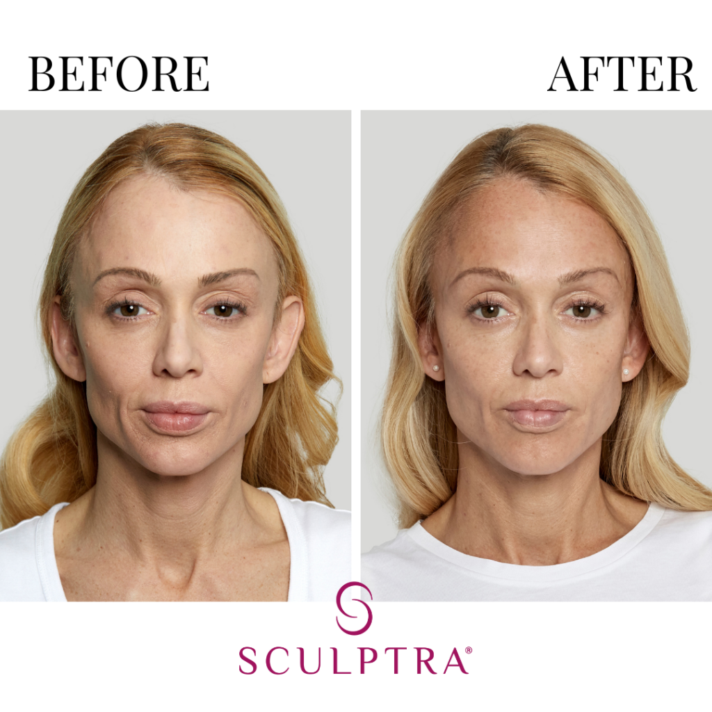 Botox + Fillers Before and Afters B &A (29)