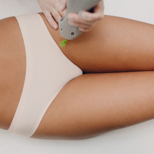 Women getting laser hair removal near her bikini line. 