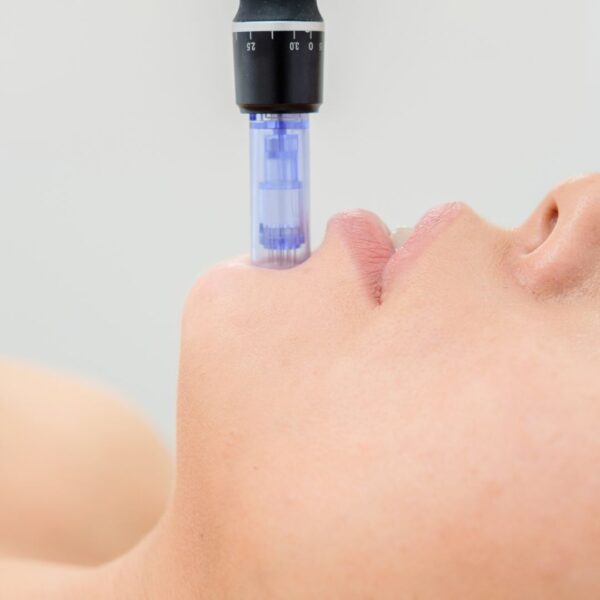 Person getting microneedling on their chin. 