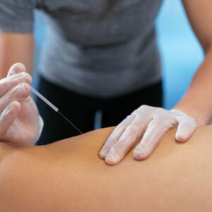 person doing acupuncture