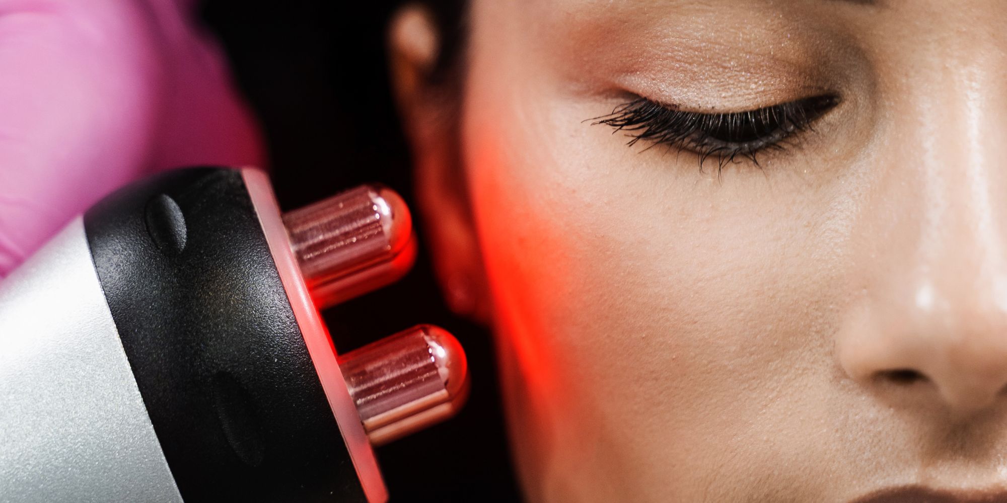 Can BBL Help with Fine Lines and Wrinkles A Detailed Look