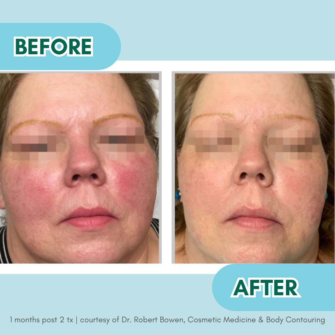 Rosacea BBL