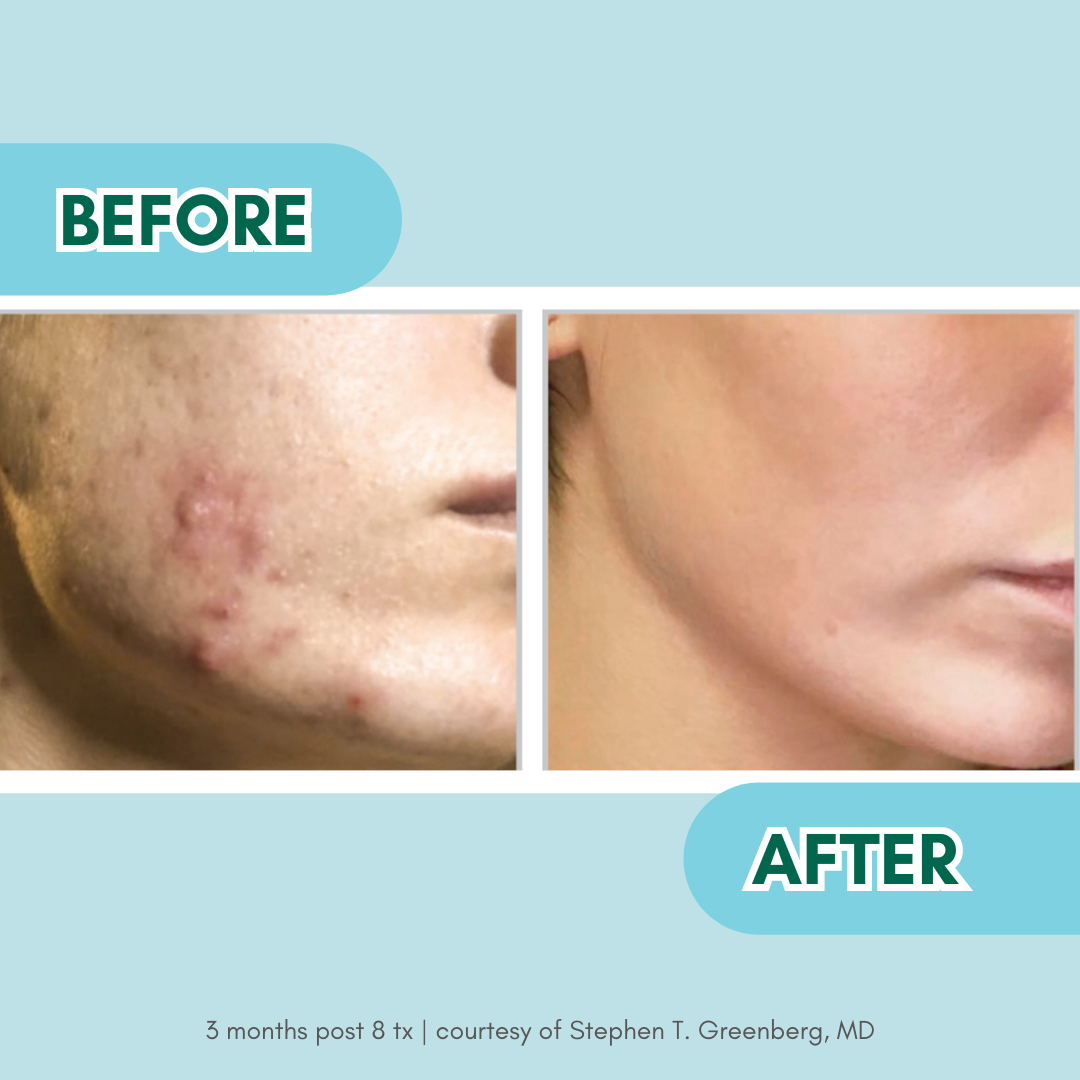 acne BBL