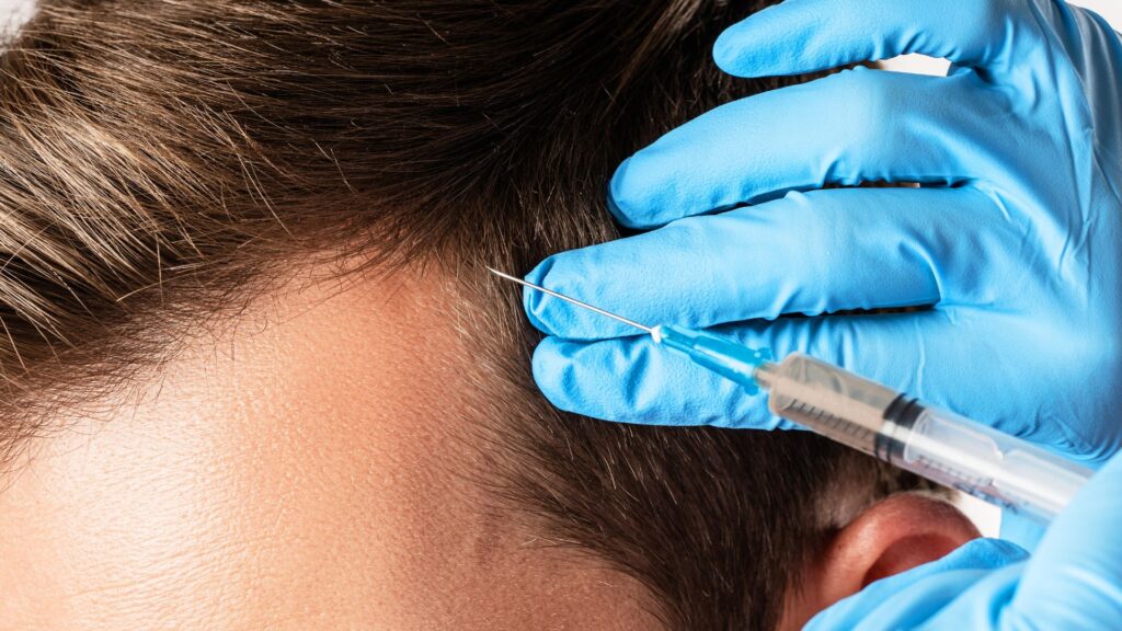 injection carefully into hairline to correct male pattern baldness