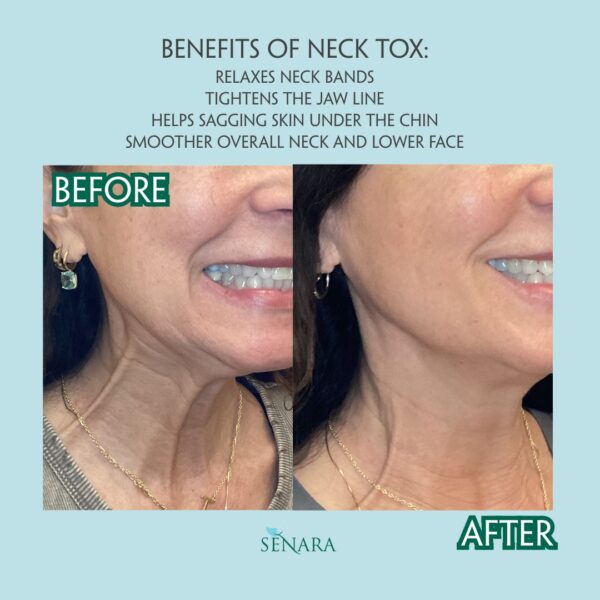 benefits of neck tox