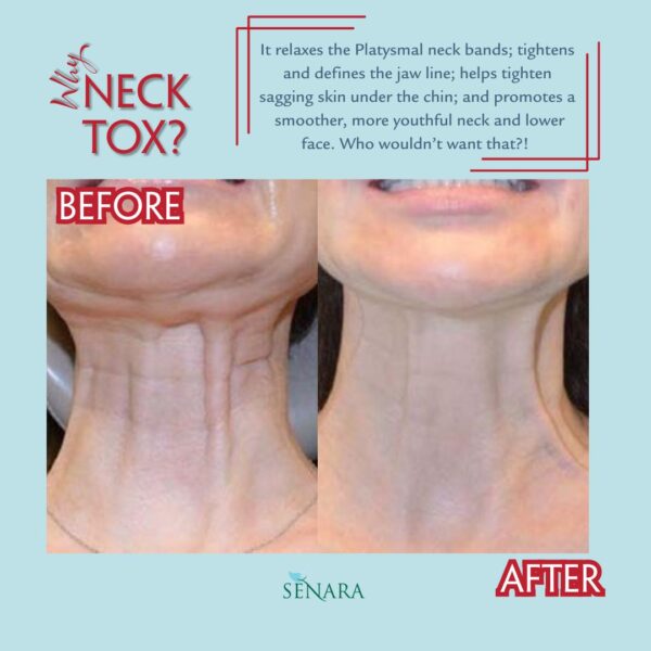 before and after neck tox images