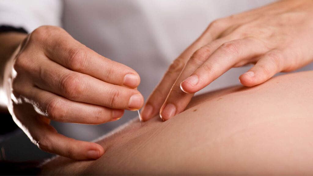 acupuncture