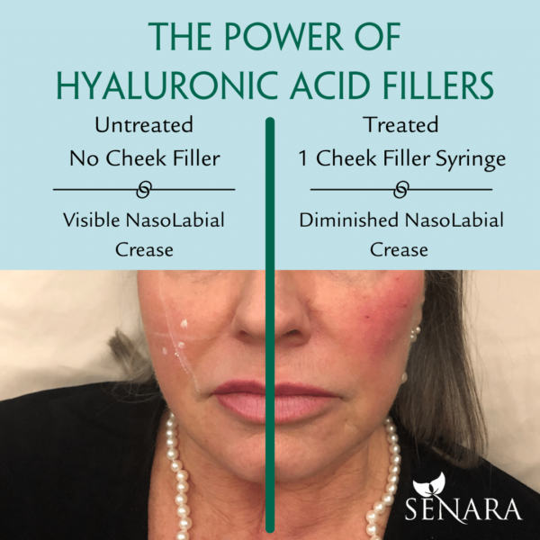 The-Power-of-Cheek-Fillers-61ba6595b7bfc-600x600