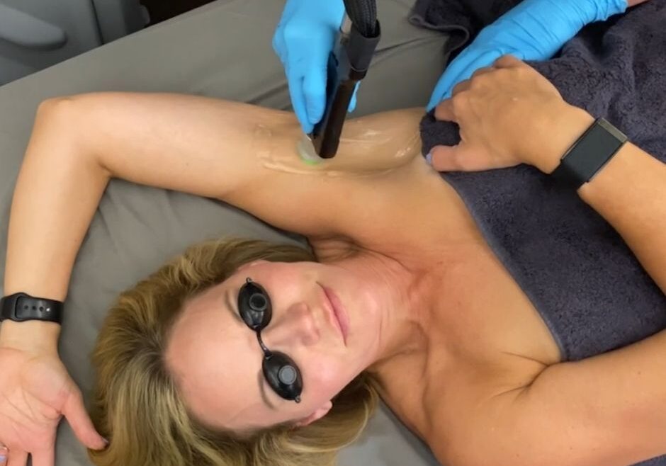 woman getting laser hair removal on armpit